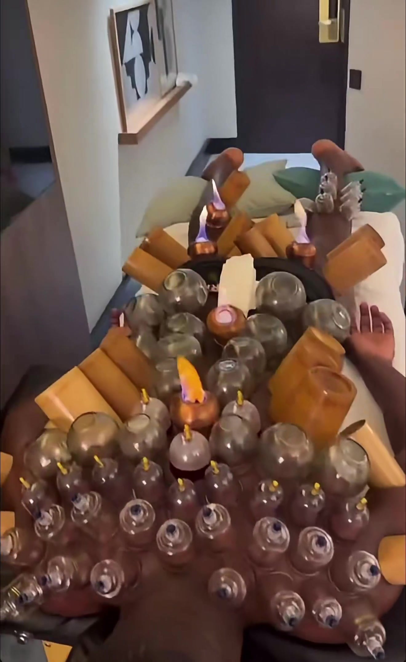 满背都是火罐！奥纳纳晒密集拔罐视频，网友：直接变刺猬了！